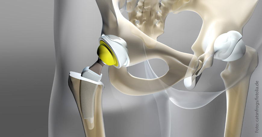 Hüftprothese Burscheid